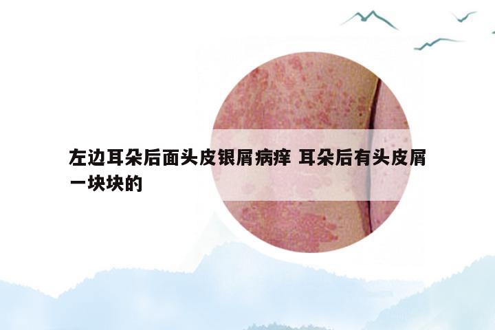 左边耳朵后面头皮银屑病痒 耳朵后有头皮屑一块块的