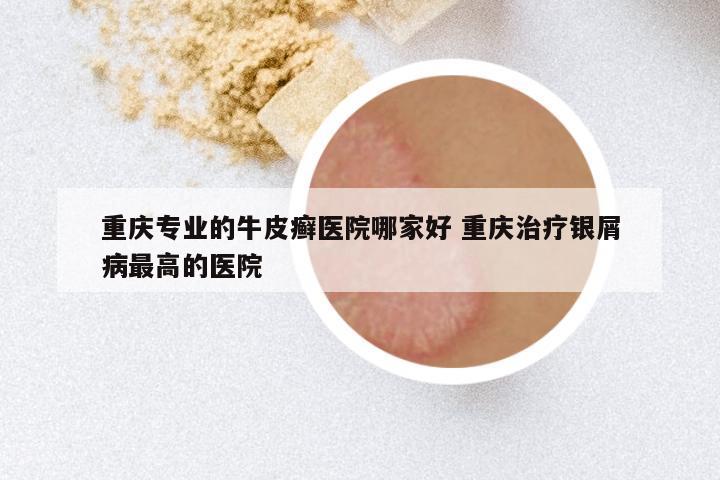 重庆专业的牛皮癣医院哪家好 重庆治疗银屑病最高的医院