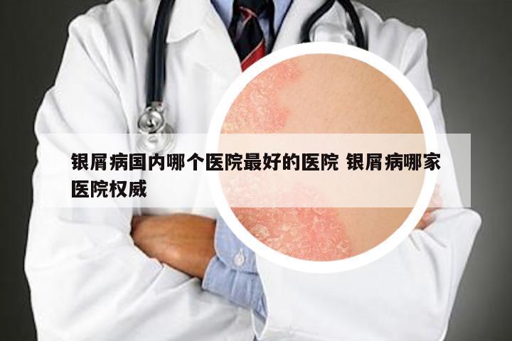 银屑病国内哪个医院最好的医院 银屑病哪家医院权威