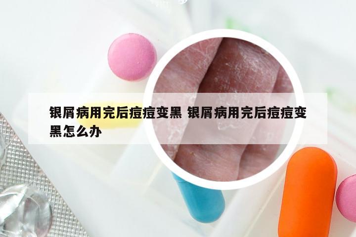 银屑病用完后痘痘变黑 银屑病用完后痘痘变黑怎么办