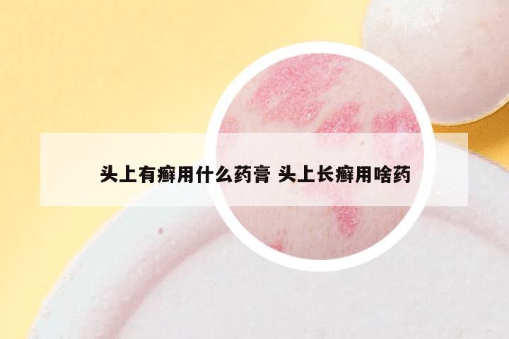 头上有癣用什么药膏 头上长癣用啥药