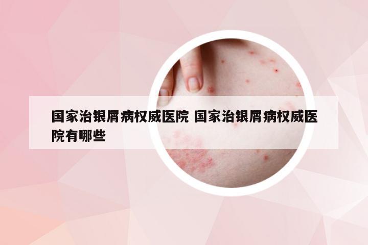 国家治银屑病权威医院 国家治银屑病权威医院有哪些