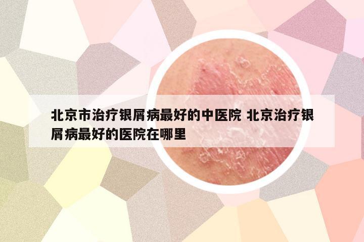 北京市治疗银屑病最好的中医院 北京治疗银屑病最好的医院在哪里