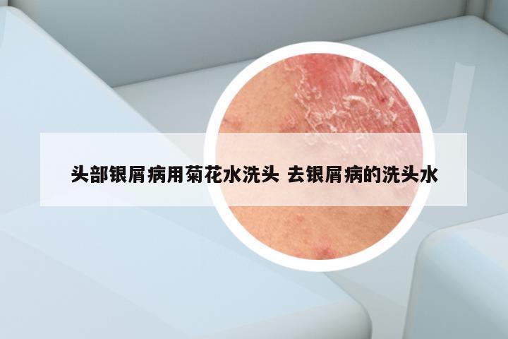 头部银屑病用菊花水洗头 去银屑病的洗头水