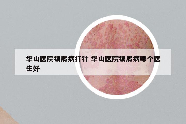 华山医院银屑病打针 华山医院银屑病哪个医生好
