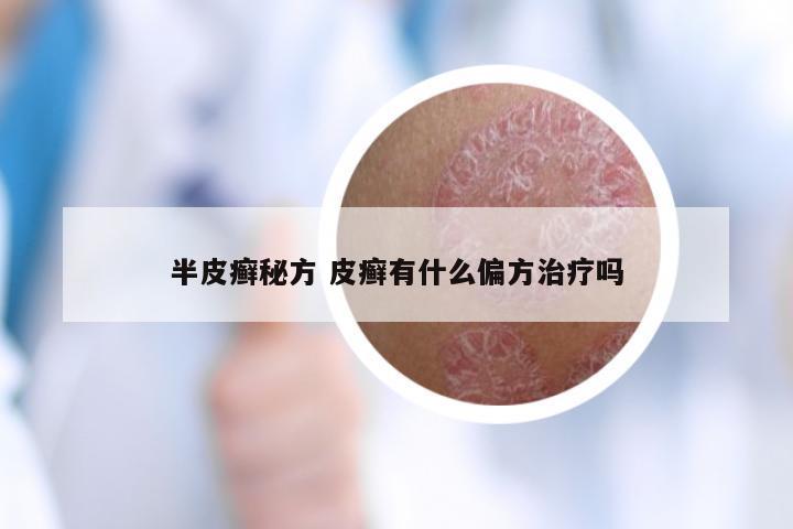 半皮癣秘方 皮癣有什么偏方治疗吗