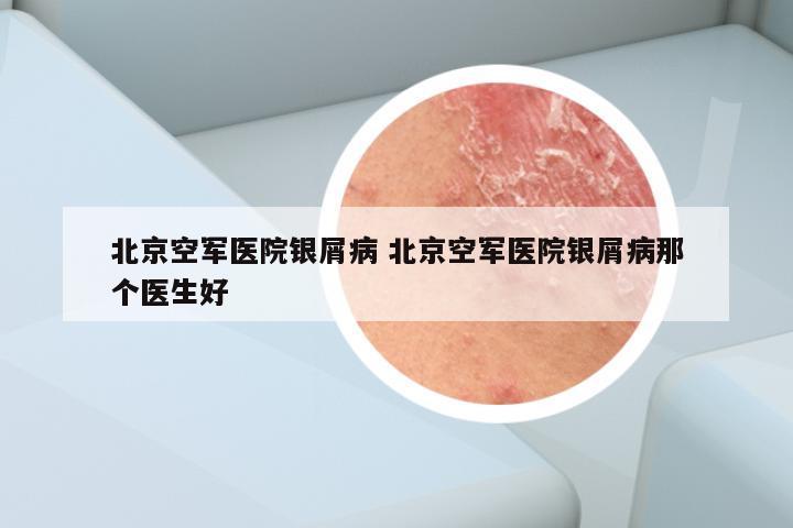 北京空军医院银屑病 北京空军医院银屑病那个医生好