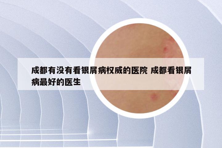 成都有没有看银屑病权威的医院 成都看银屑病最好的医生