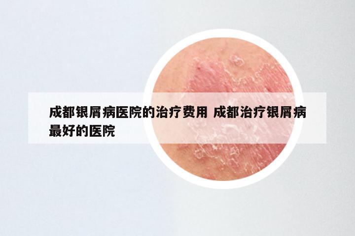 成都银屑病医院的治疗费用 成都治疗银屑病最好的医院
