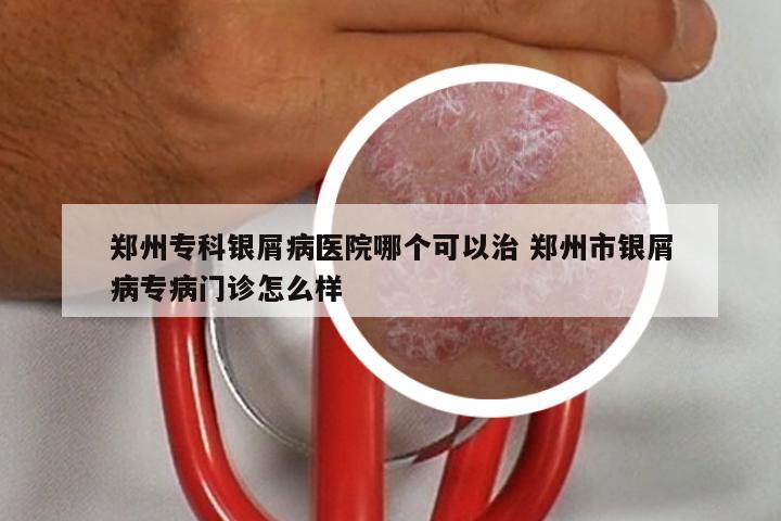 郑州专科银屑病医院哪个可以治 郑州市银屑病专病门诊怎么样