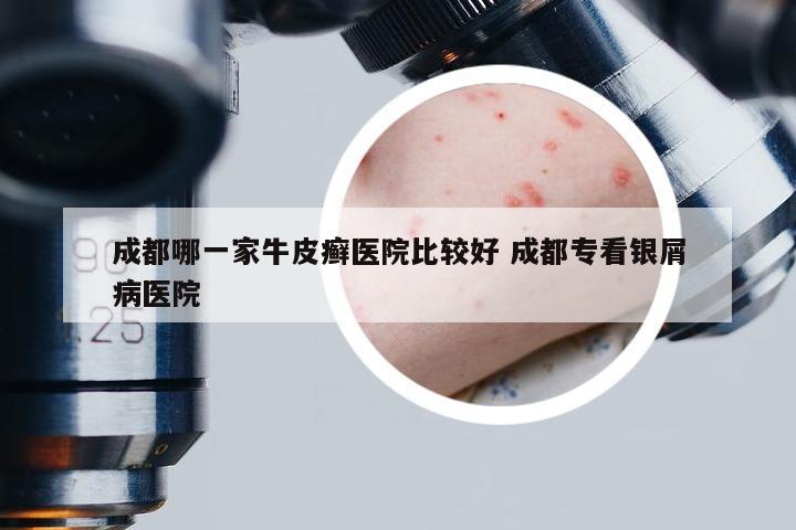 成都哪一家牛皮癣医院比较好 成都专看银屑病医院