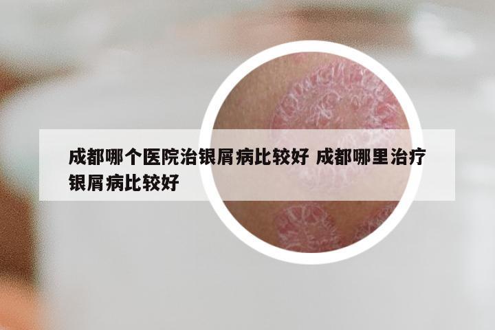 成都哪个医院治银屑病比较好 成都哪里治疗银屑病比较好