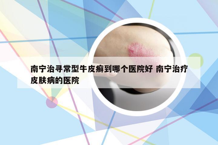 南宁治寻常型牛皮癣到哪个医院好 南宁治疗皮肤病的医院