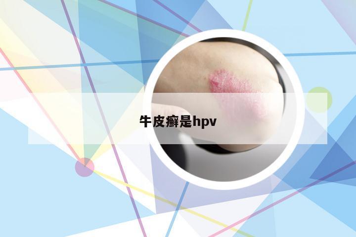 牛皮癣是hpv