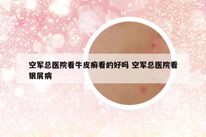 空军总医院看牛皮癣看的好吗 空军总医院看银屑病