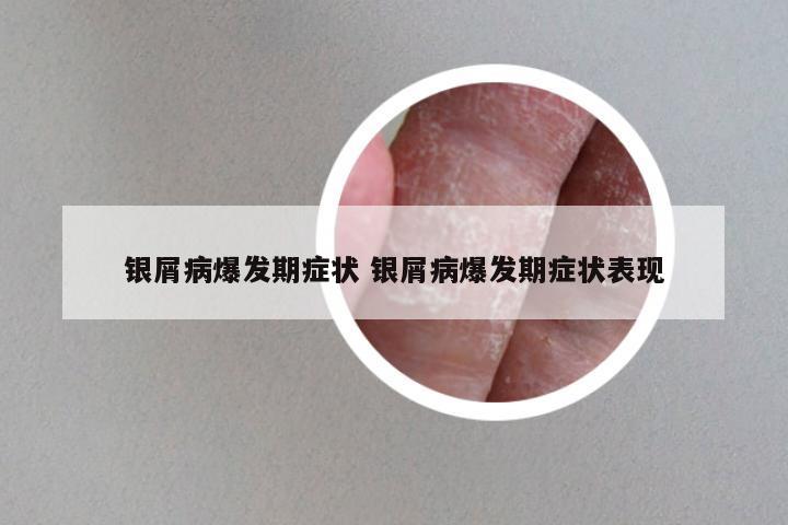 银屑病爆发期症状 银屑病爆发期症状表现