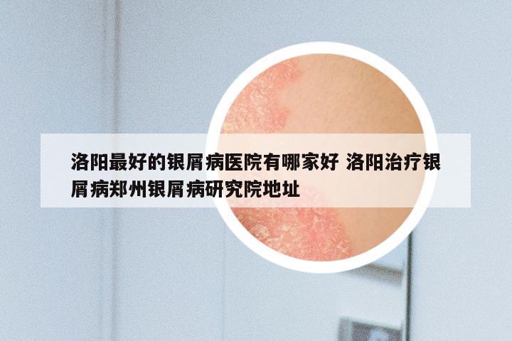 洛阳最好的银屑病医院有哪家好 洛阳治疗银屑病郑州银屑病研究院地址