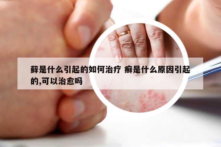 藓是什么引起的如何治疗 癣是什么原因引起的,可以治愈吗