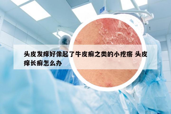 头皮发痒好像起了牛皮癣之类的小疙瘩 头皮痒长癣怎么办