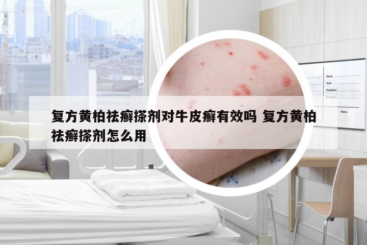 复方黄柏祛癣搽剂对牛皮癣有效吗 复方黄柏祛癣搽剂怎么用