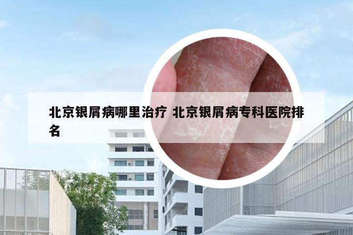北京银屑病哪里治疗 北京银屑病专科医院排名