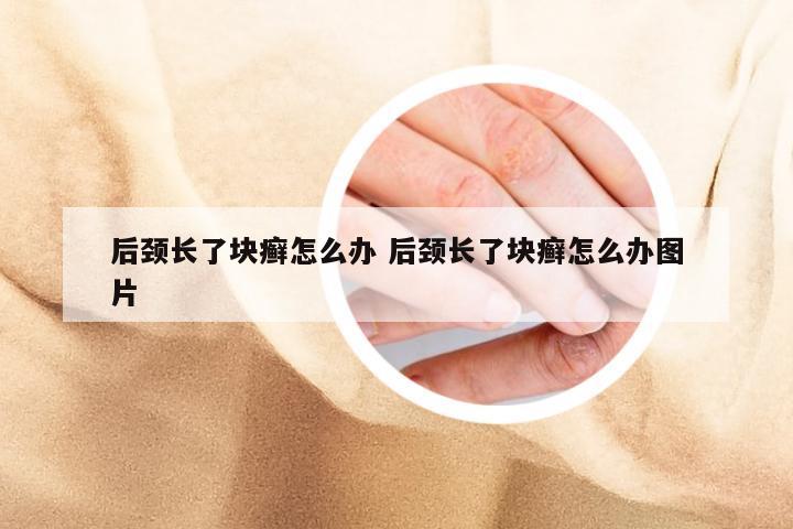 后颈长了块癣怎么办 后颈长了块癣怎么办图片