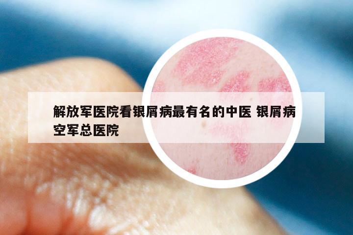 解放军医院看银屑病最有名的中医 银屑病 空军总医院
