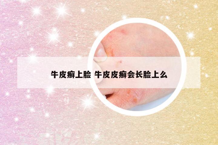 牛皮癣上脸 牛皮皮癣会长脸上么