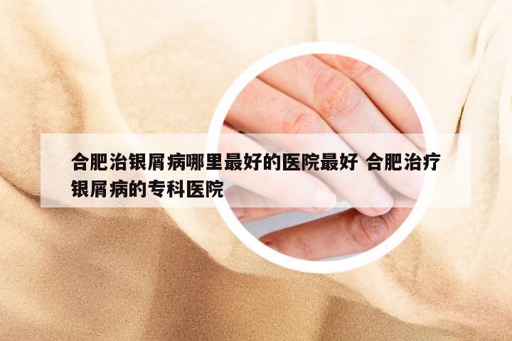 合肥治银屑病哪里最好的医院最好 合肥治疗银屑病的专科医院