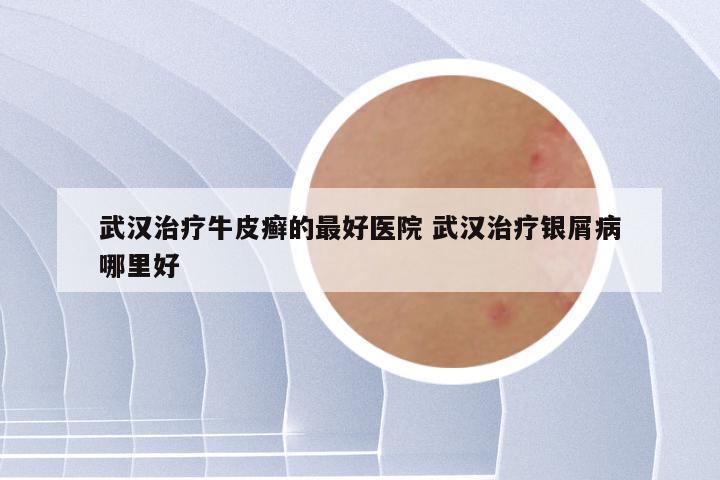 武汉治疗牛皮癣的最好医院 武汉治疗银屑病哪里好