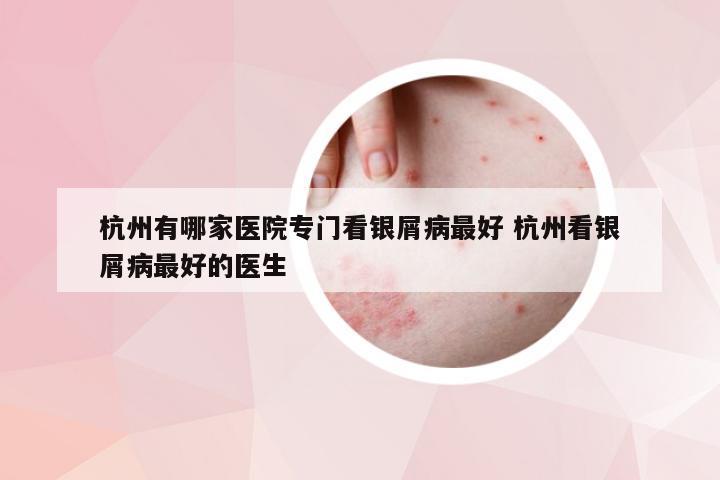 杭州有哪家医院专门看银屑病最好 杭州看银屑病最好的医生