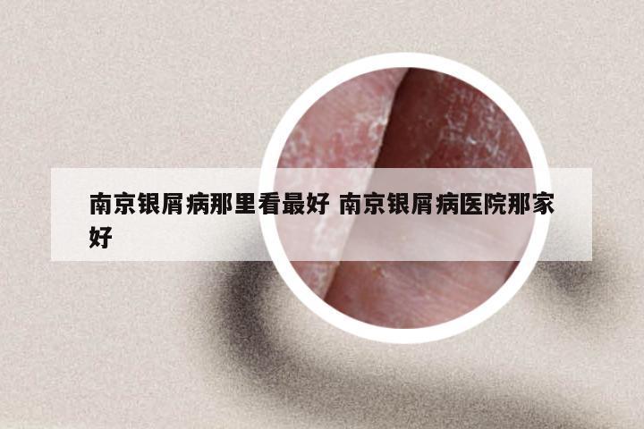 南京银屑病那里看最好 南京银屑病医院那家好
