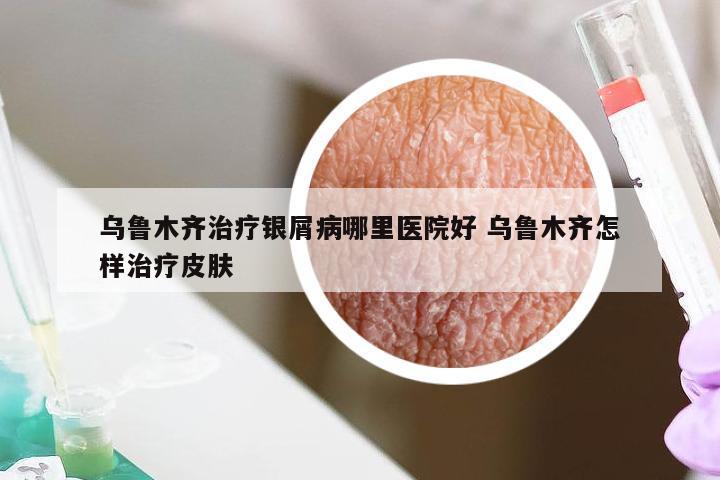 乌鲁木齐治疗银屑病哪里医院好 乌鲁木齐怎样治疗皮肤