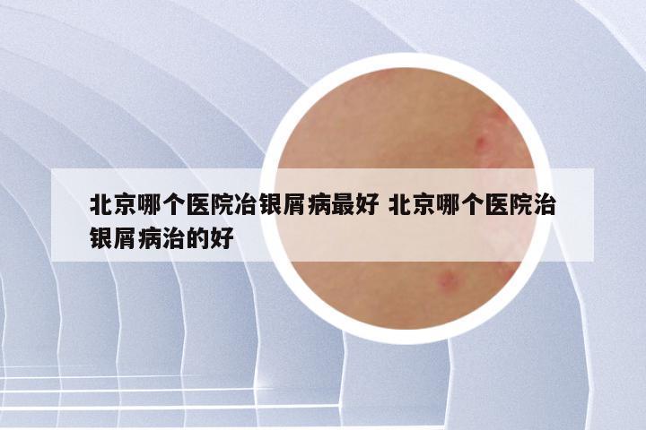 北京哪个医院冶银屑病最好 北京哪个医院治银屑病治的好