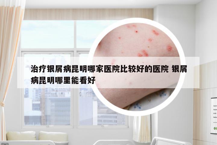 治疗银屑病昆明哪家医院比较好的医院 银屑病昆明哪里能看好