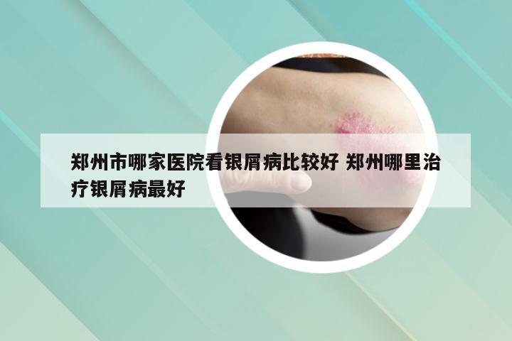 郑州市哪家医院看银屑病比较好 郑州哪里治疗银屑病最好