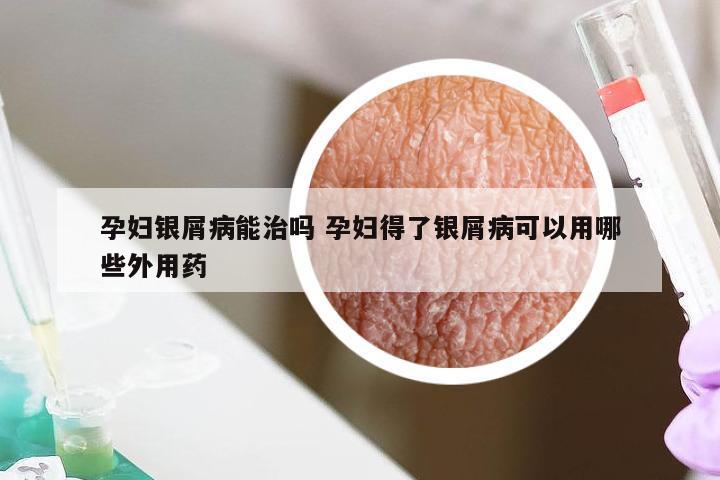 孕妇银屑病能治吗 孕妇得了银屑病可以用哪些外用药