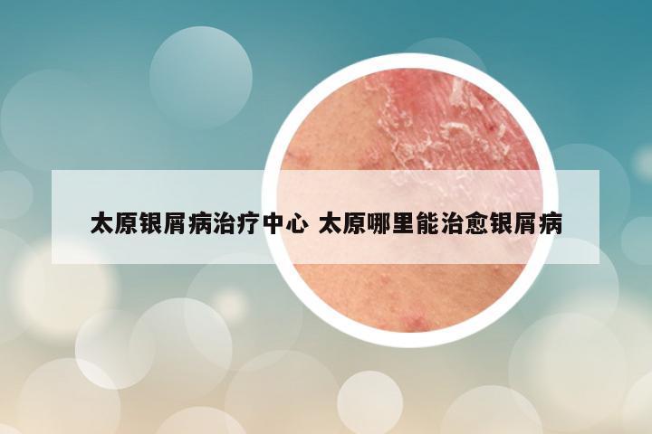 太原银屑病治疗中心 太原哪里能治愈银屑病