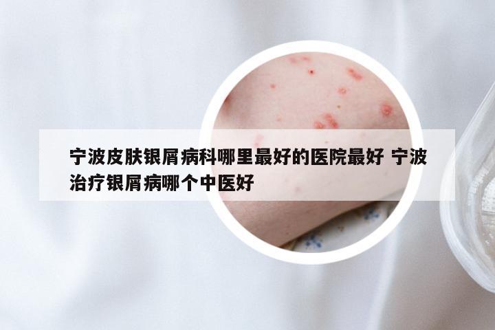 宁波皮肤银屑病科哪里最好的医院最好 宁波治疗银屑病哪个中医好