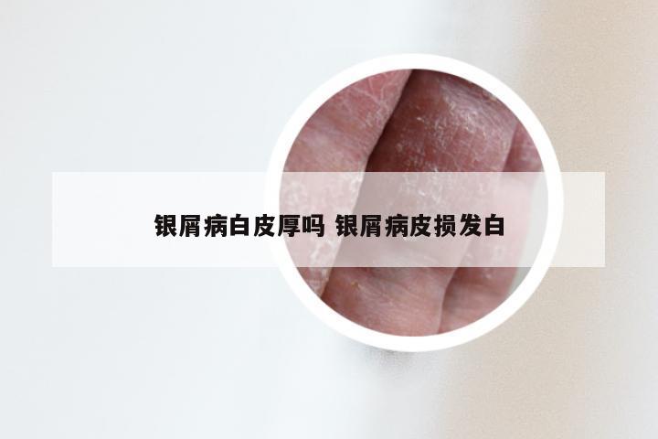 银屑病白皮厚吗 银屑病皮损发白