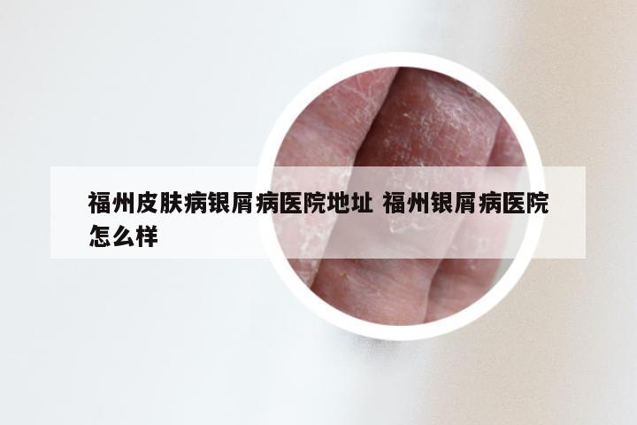 福州皮肤病银屑病医院地址 福州银屑病医院怎么样