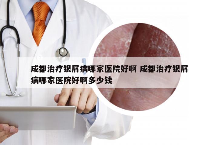 成都治疗银屑病哪家医院好啊 成都治疗银屑病哪家医院好啊多少钱