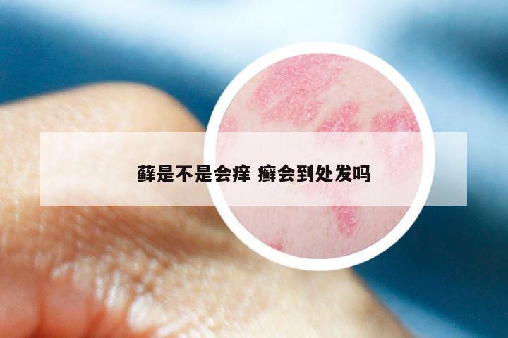 藓是不是会痒 癣会到处发吗
