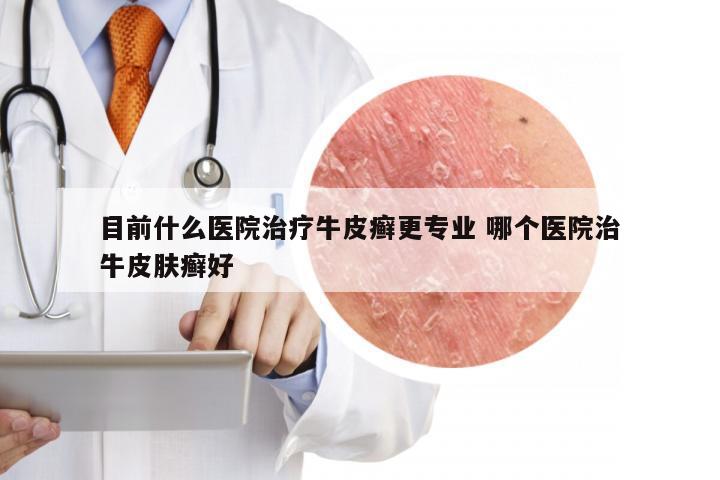 目前什么医院治疗牛皮癣更专业 哪个医院治牛皮肤癣好