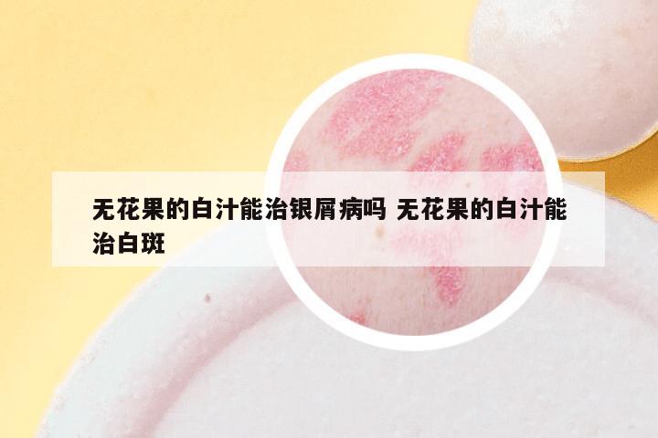 无花果的白汁能治银屑病吗 无花果的白汁能治白斑