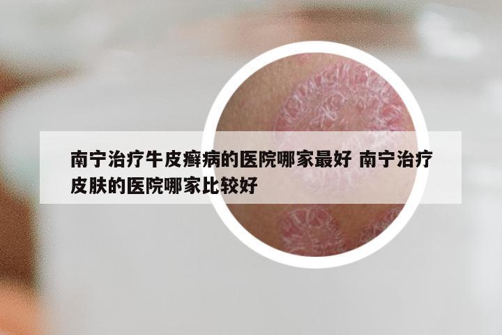 南宁治疗牛皮癣病的医院哪家最好 南宁治疗皮肤的医院哪家比较好