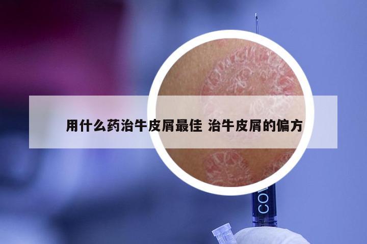 用什么药治牛皮屑最佳 治牛皮屑的偏方