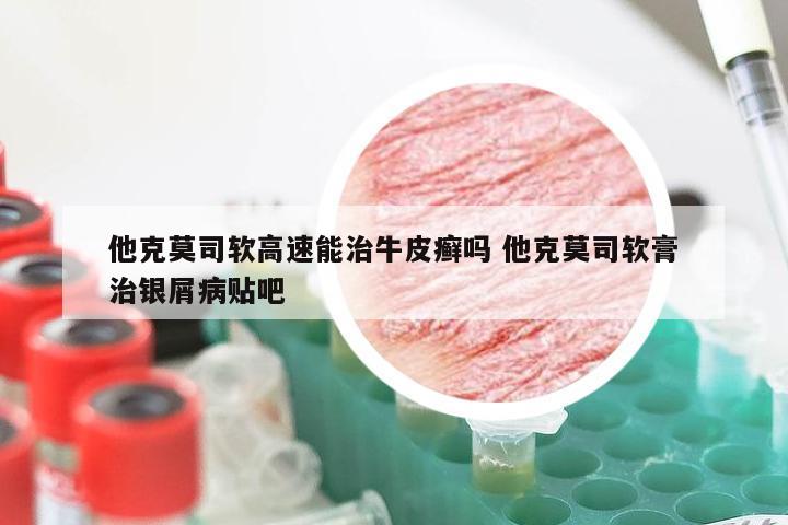 他克莫司软高速能治牛皮癣吗 他克莫司软膏治银屑病贴吧