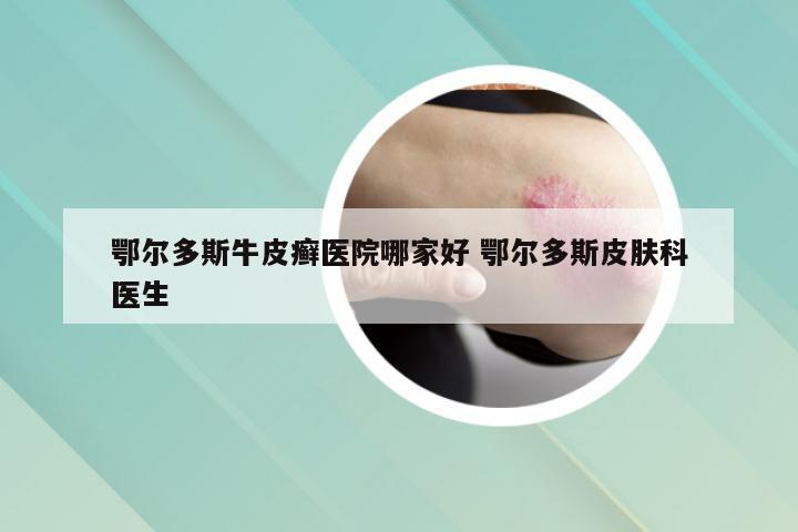 鄂尔多斯牛皮癣医院哪家好 鄂尔多斯皮肤科医生