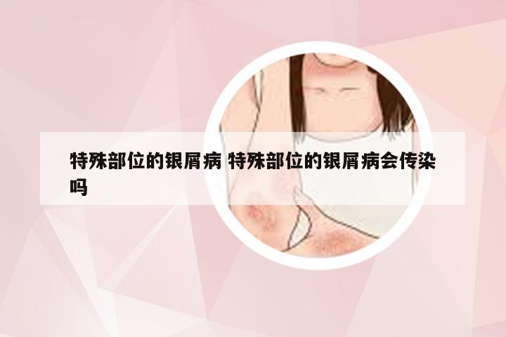 特殊部位的银屑病 特殊部位的银屑病会传染吗
